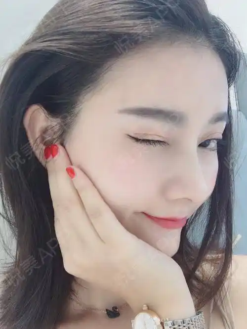 【杭州艺星鼻综合术后52天】效果越来越自然了,超开心.