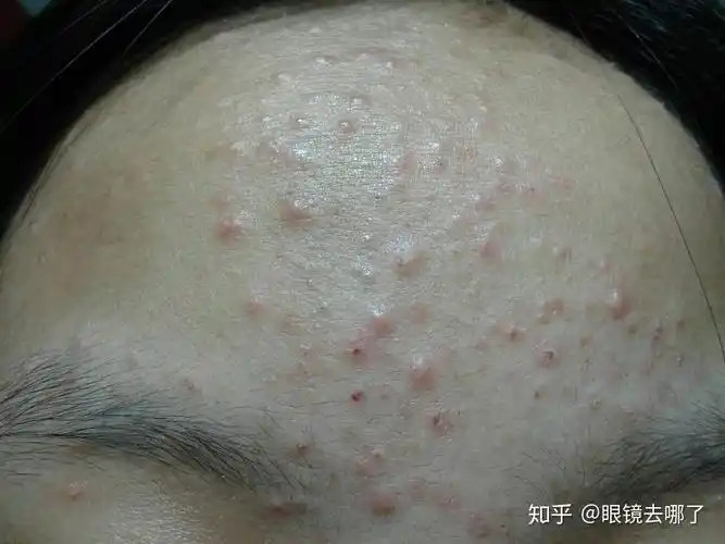 闭口粉刺怎么去除