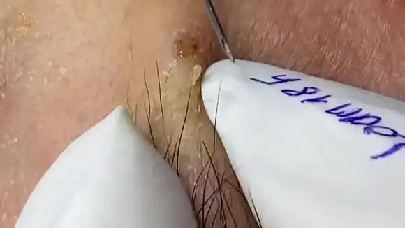 龙姑娘挤痘痘:周末最好的黑头【108】