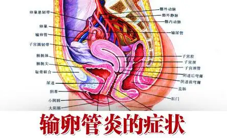慢性输卵管炎是导致输卵管不孕的一种疾病