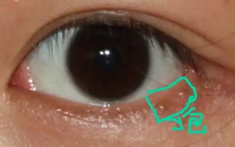 下眼睑有些下垂怎么办