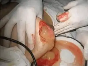 奥美定取出后还有硬结是为什么?