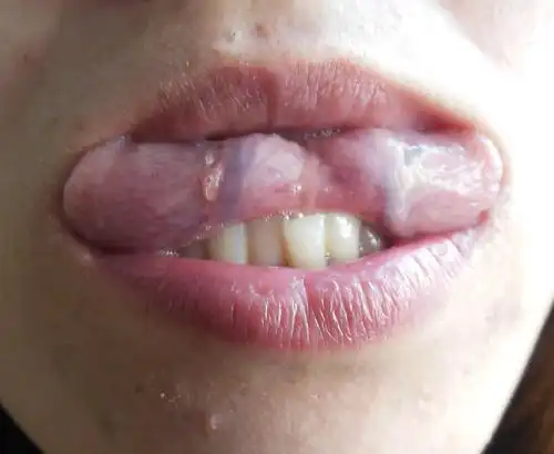 各位大侠看一下舌底这些芒刺是什么