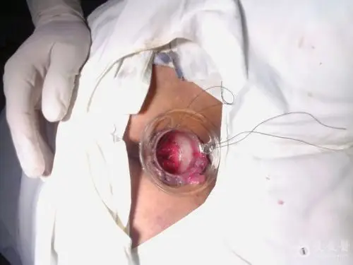 环状混合痔--pph术