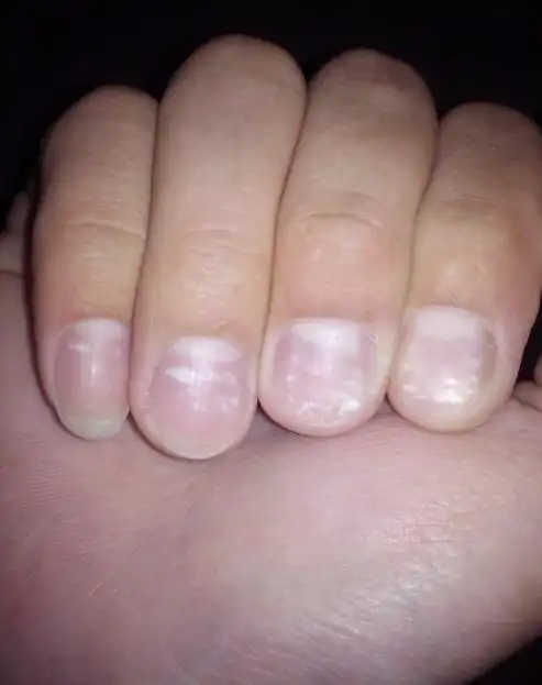 指甲如图所示的白斑,如何治疗?