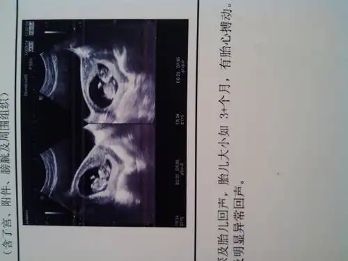 2014-08-10 刘泽群 医师 怀双胞胎能感觉出来吗?