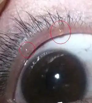 上眼皮内边缘张2个黄透明疙瘩,请问是什么?该怎么处理?