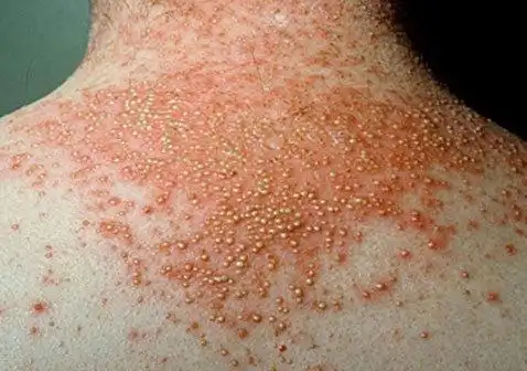 牛皮肤癣的症状图片:5种牛皮癣的症状和体征图片_银屑病求医网