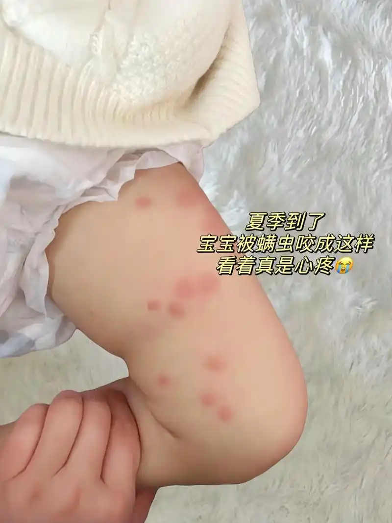 夏天是螨虫繁殖的季节,宝宝皮肤娇嫩,很容易咬出包