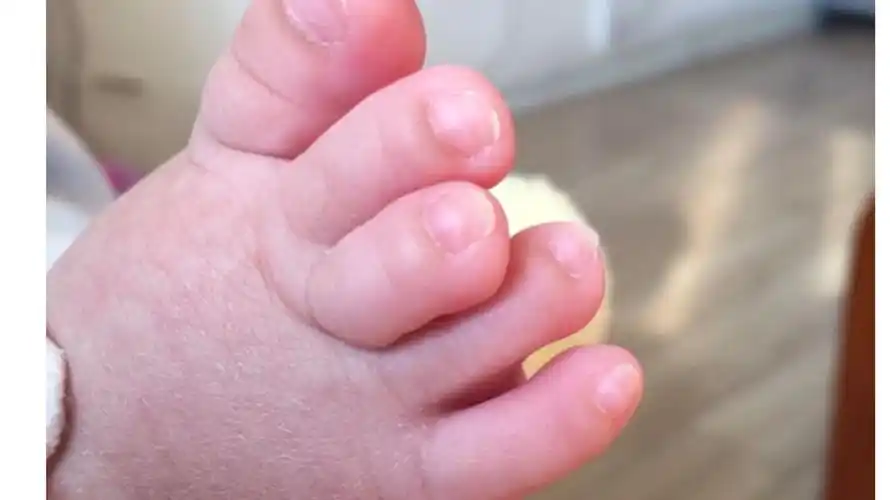 医生,五个月的宝宝脚趾可以矫正吗?