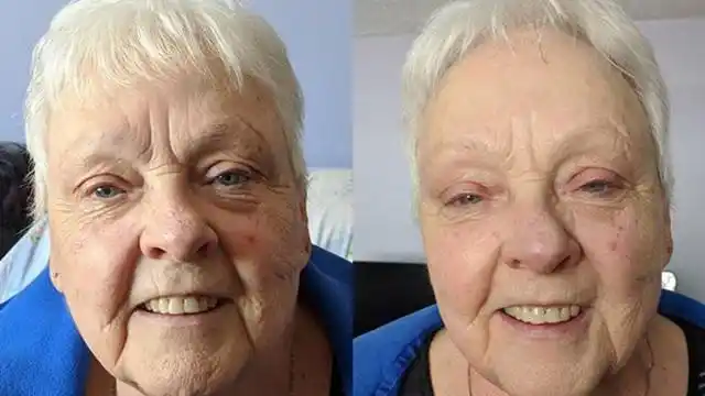 80岁老奶奶给整张脸打玻尿酸,瞬间年轻40岁!看呆了!