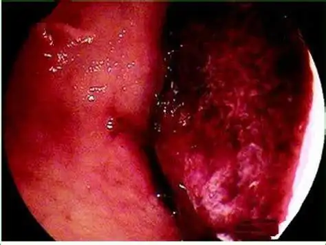 急性胃溃疡伴出血胃溃疡出血黑便自愈吗2022已更新今日资讯