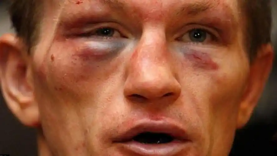 哈顿自认轻量级无敌,被帕奎奥一拳打自闭,鼻青脸肿宣布想退役