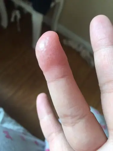 手指头上密密麻麻的小水泡,非常痒,现在严重了了感觉,肿胀一股一股