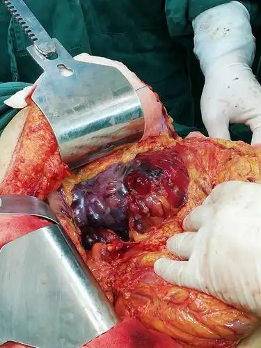 一名巨大胰腺肿瘤患者在临沧市第二人民医院得到成功救治