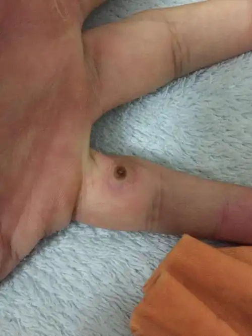 手上长的瘊子怎么治疗