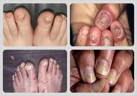 指甲为什么得银屑病的原因及症状图片-中华银屑病网