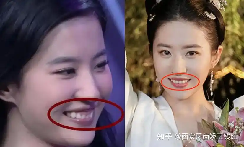 牙列拥挤,地包天,高位虎牙,牙齿矫正塑造温柔侧颜!