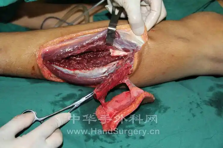 游离腓骨皮瓣修复足第一序列