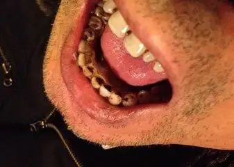 牙齿发黑洗牙可以去除吗