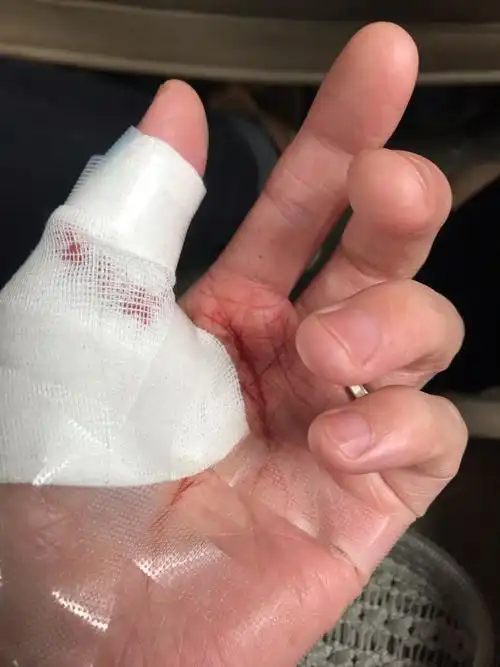 大拇指虎口被刀割破了还能打王者吗