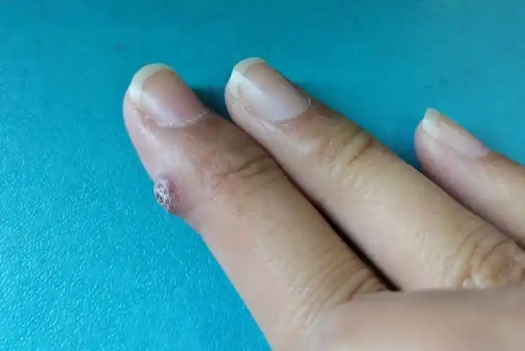 皮肤伤口愈合过程皮肤外伤后愈合时,可见粉红色至鲜红色的颗粒状肉芽