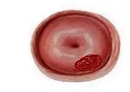 [准备怀孕]去年做过leep,现在宫颈上又疤痕