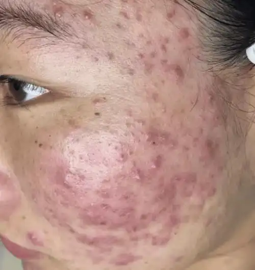 这样的痘痘脸,试一下皙岛页岩油精华液?