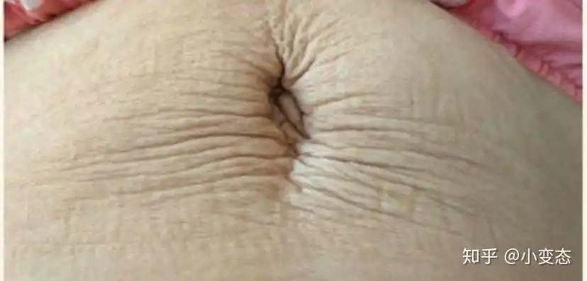 腹壁整形手术你真的适合吗全网最全腹壁整形相关知识