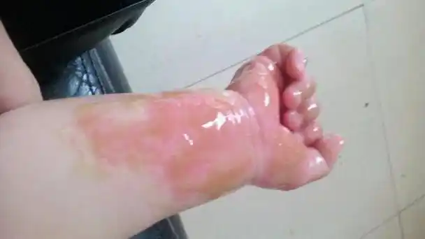 孩子烫伤了第一时间怎么处理(孩子烫伤后该怎么办)(3)