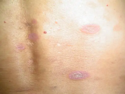 典型的扁平苔藓1例