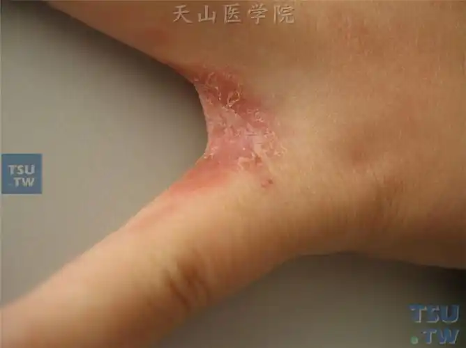 手癣(tinea manus)的症状表现 - 皮肤病学 - 天山医学院