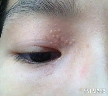 【图】眼部扁平疣发危害有哪些 为你浅析扁平疣的3个症状