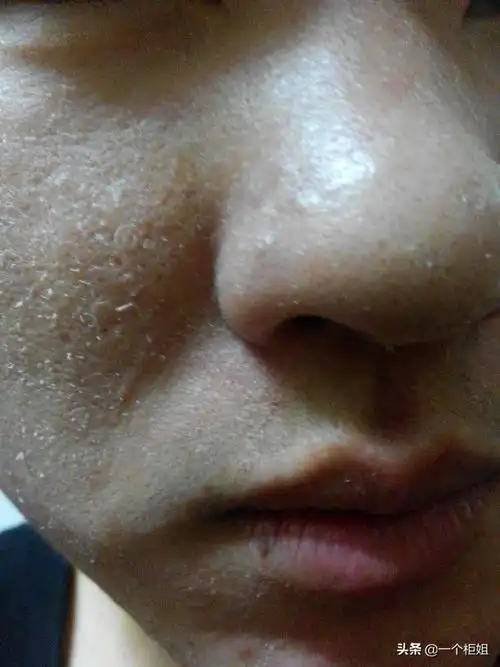 洗完脸后脸上起白皮怎么办(脸上起白皮的原因是什么)-四五百科