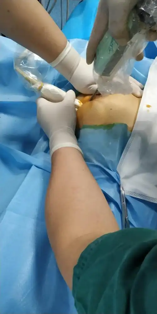 乳腺旋切手术中