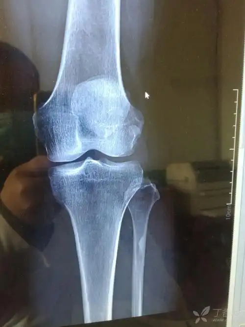 左膝关节正侧位片一例,请各位老师看一下.