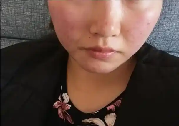 有些人的皮肤会出现过敏的现象,一旦过敏,真的是很难受.