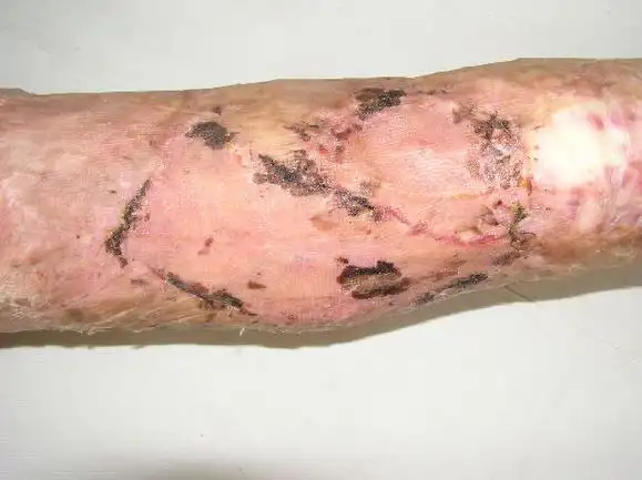 瘢痕挛缩植皮术1年后效果 - 好大夫在线