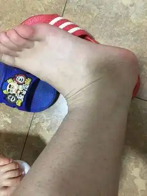 有没有这种脚踝处鼓包的现象早上没晚上洗脚前有洗完脚一会又没