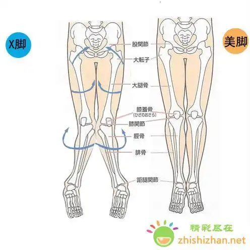怎样才能不做手术矫正x型腿