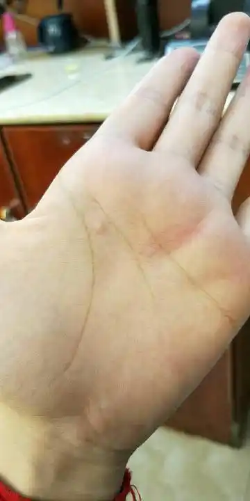 手心长个包,不小心按着东西硌着感觉整只手都疼,请问这是啥