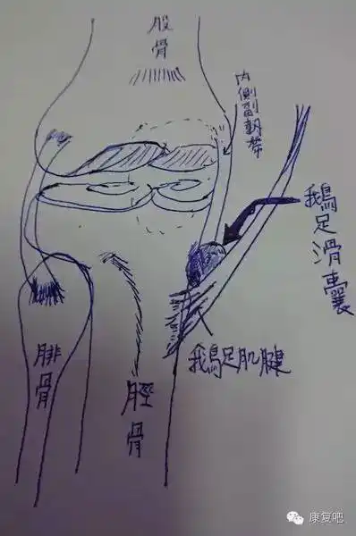 (退化性关节炎), 滑囊炎(bursitis), 最常见的是 鹅足滑囊炎(anserine