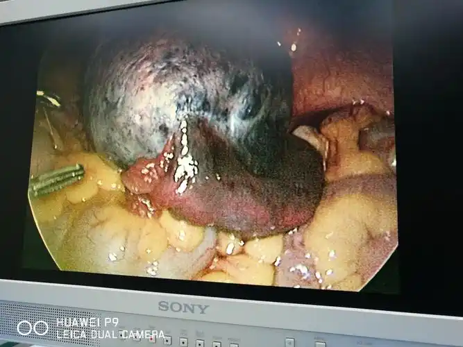 病历分享妊娠合并卵巢囊肿蒂扭转