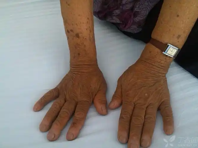 【病例讨论】干燥综合征由手术诱发? [病例帖]