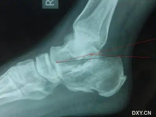 跟骨骨折后gissane角/bohler 角的测量问题