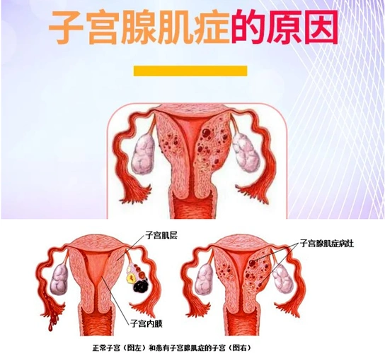 郑州管城康氏中医馆子宫腺肌症医案