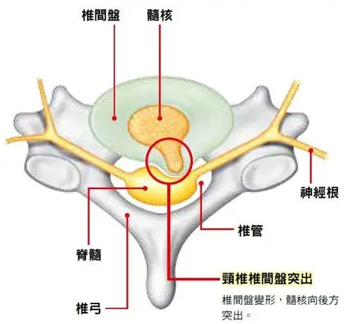 脖子,肩痛注意椎间盘突出,1动作测出颈椎健康