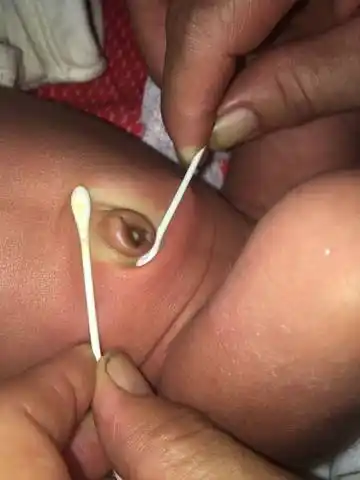 脐尿管瘘,才18天该不该手术?