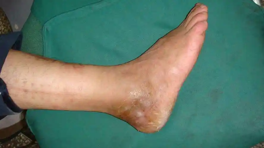 跟骨骨髓炎的治疗 - 好大夫在线