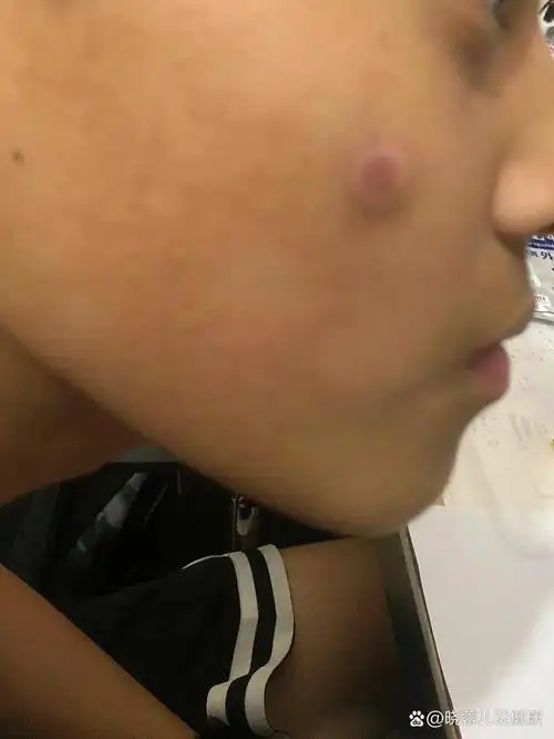 超大痘痘?结节囊肿?这到底是什么?